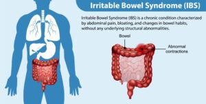 IBS-C in Brief